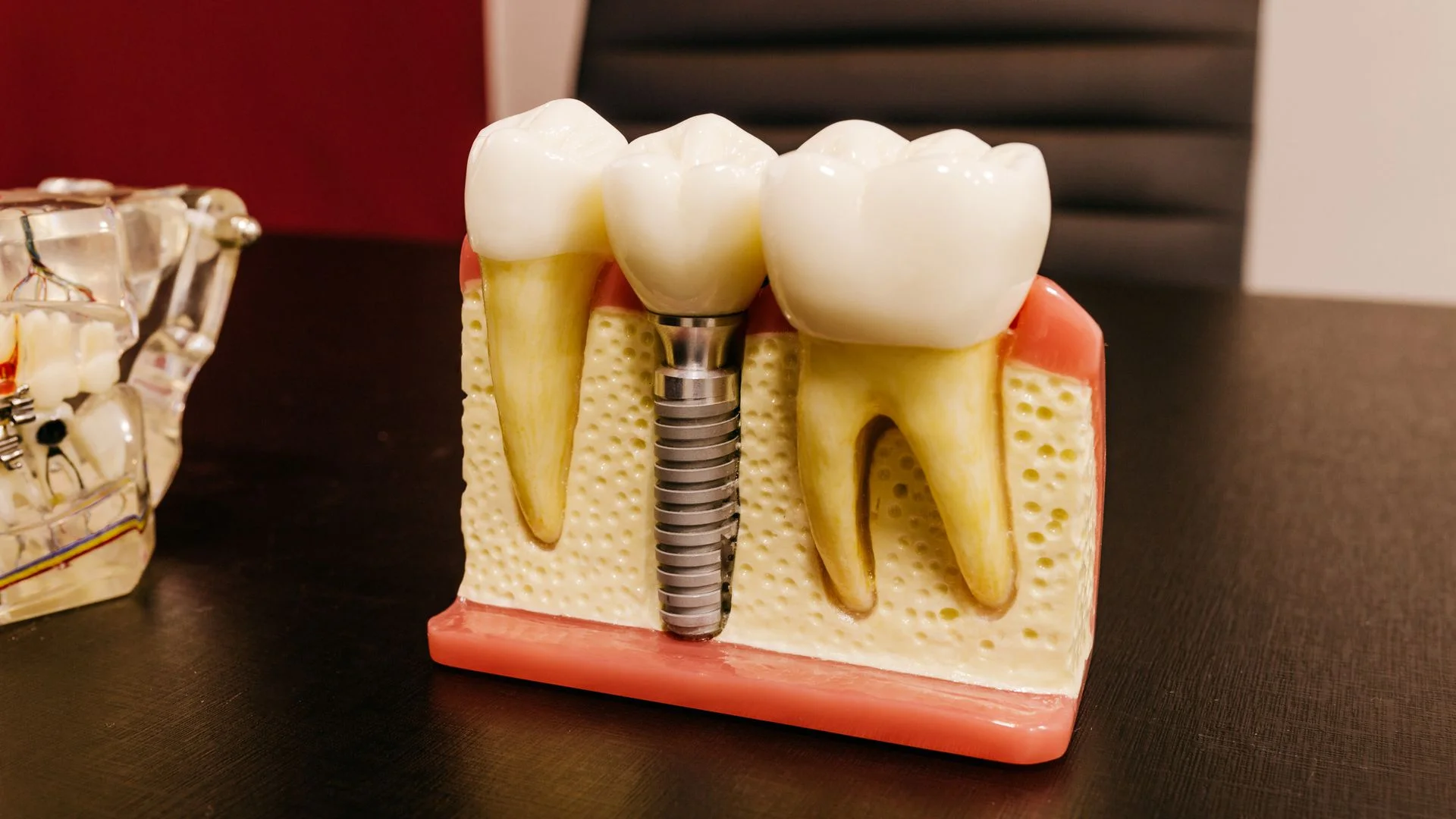 Implante Dentário — Odontubel